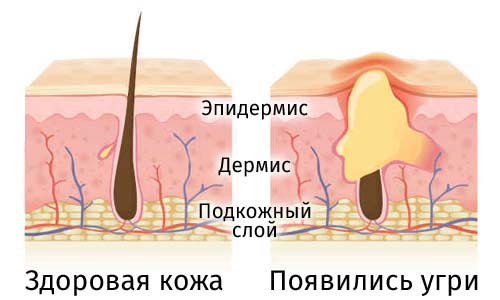 Схема развития акне